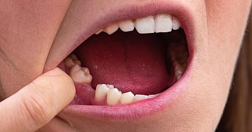 Eksik Dişler Sağlığımızı olumsuz etkiliyor